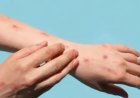 China's decree after the first case of monkeypox, do not come in contact with people who have returned from abroad